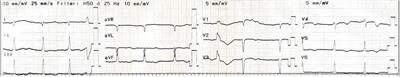 Successful percutaneous coronary intervention of left main coronary artery dissection following mechanical aortic valve replacement surgery: a case report and literature review